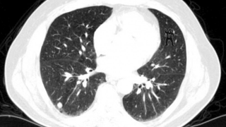 83 Percent of Radiologists Didn't Spot the Gorilla Hiding in This CT Scan